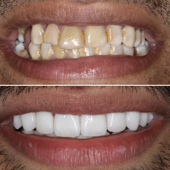 Before - naveed patel