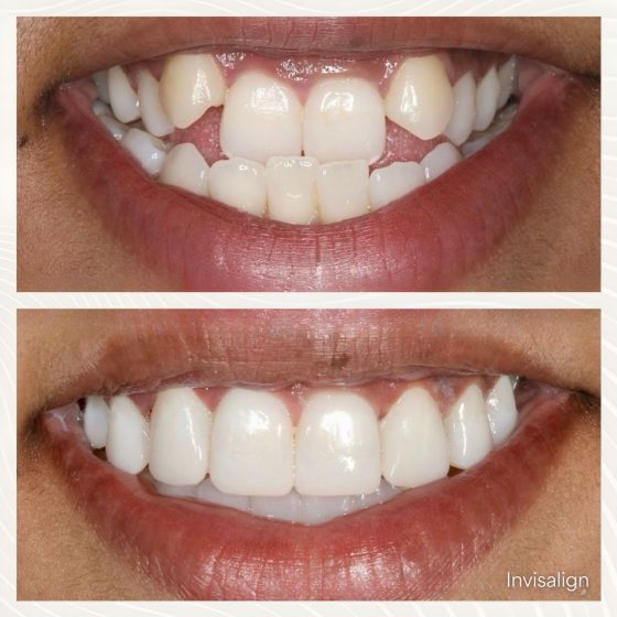 Before - naveed patel