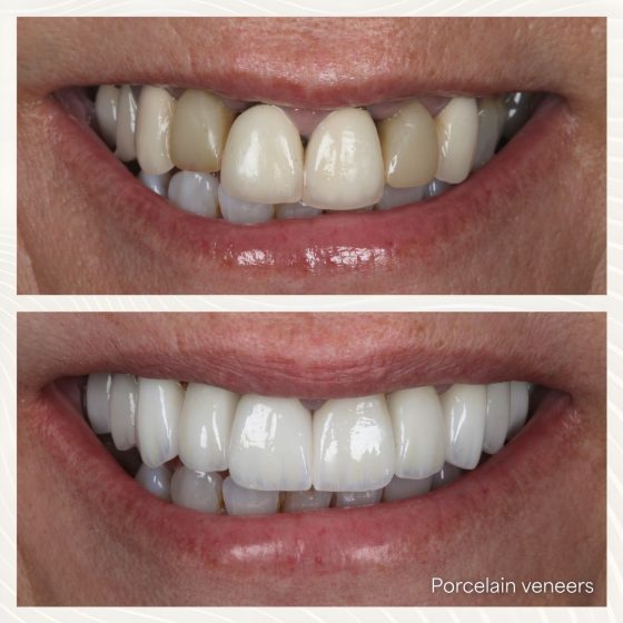 Before - naveed patel