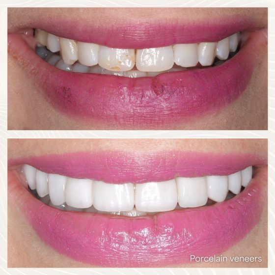 Before - naveed patel