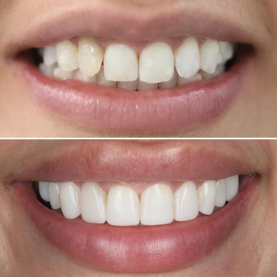 Before - naveed patel